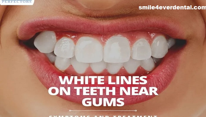 Teeth Break at Gum Line Causes Symptoms and Care