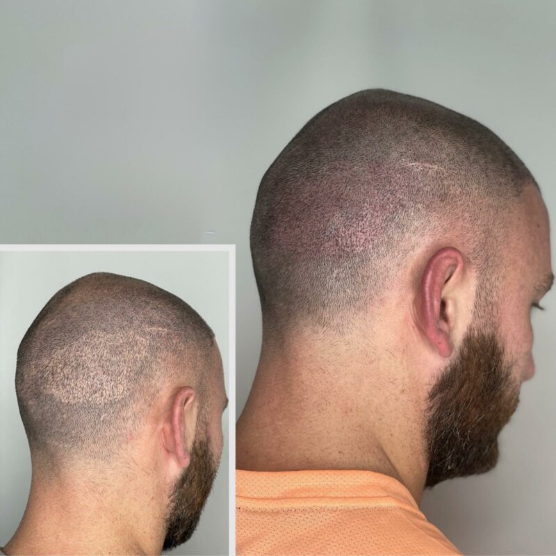 scar camouflage tattoo