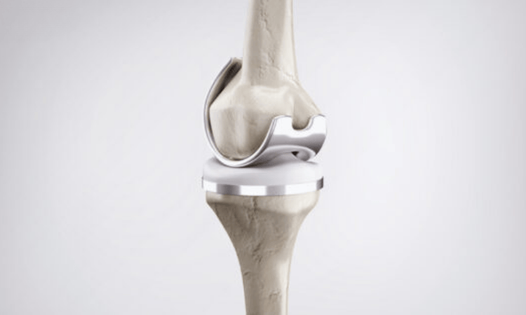 Knee Replacement in Jaipur
